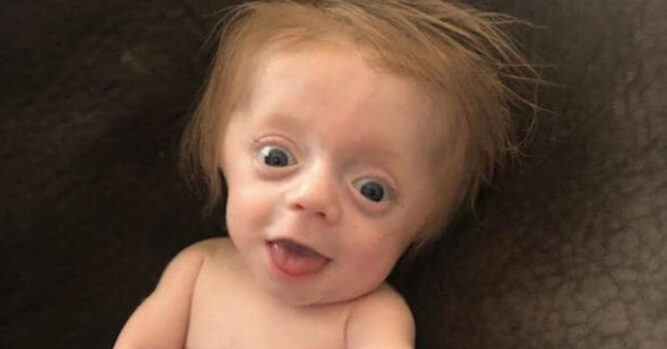 Newborn Diagnosed With Brittle Bone Disease Defies All Odds – Inner ...
