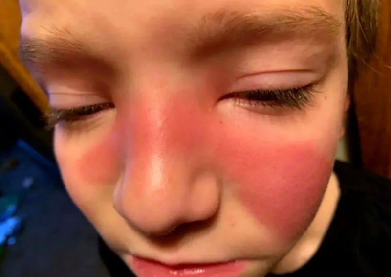 Parents Need To Look Out For Facial Red Marks Which Could ...