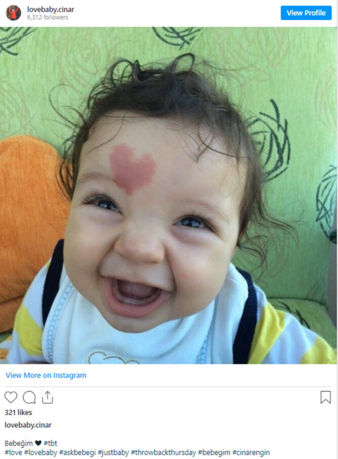 a-baby-boy-was-born-with-a-heart-shaped-birthmark-on-his-forehead