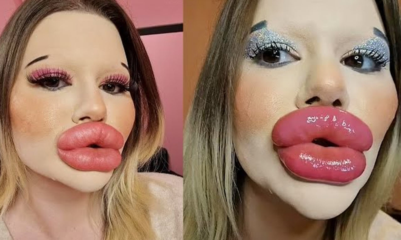 Young Woman Has 27 Procedures To Get The Biggest Lips In The World